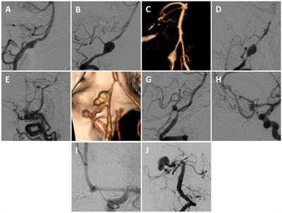 Combined open revascularization and endovascular treatment of complex intracranial aneurysms: case series